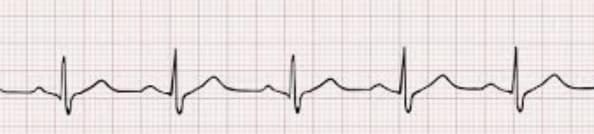 ECG chart
